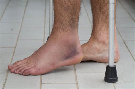 Is it OK to walk on injured foot?