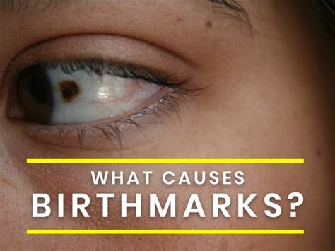 Is it bad to have a birthmark?