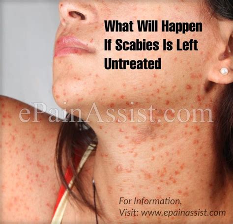 Is it bad to leave a rash untreated?