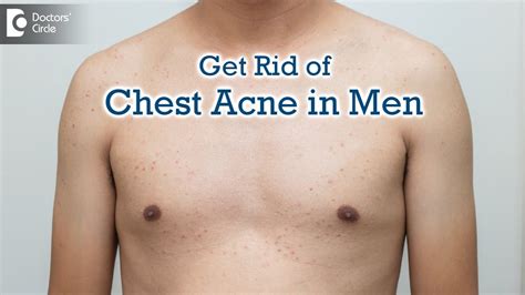 Is it bad to pick at chest acne?