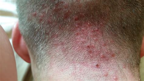 Is it bad to scratch folliculitis?