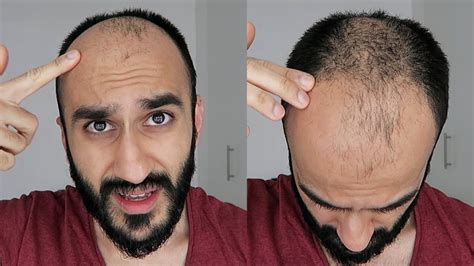 Is it better to be bald or balding?