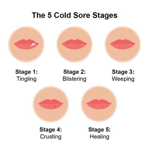 Is it better to dry out a cold sore?