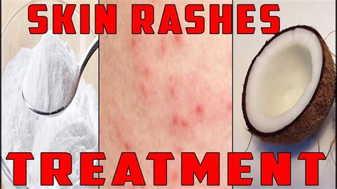 Is it better to keep a rash dry or moist?
