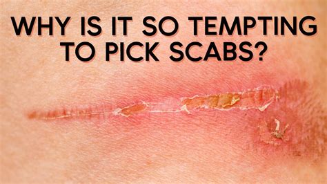 Is it better to pick a scab or leave it?