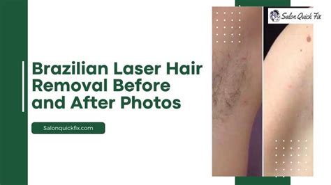 Is it embarrassing to get a Brazilian laser?