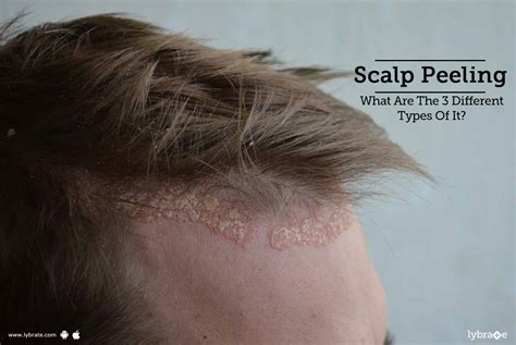 Is it good to peel your scalp?
