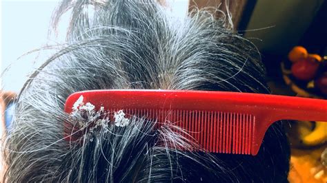 Is it good to scrape your scalp with a comb?