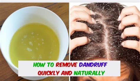 Is it healthy to comb out dandruff?