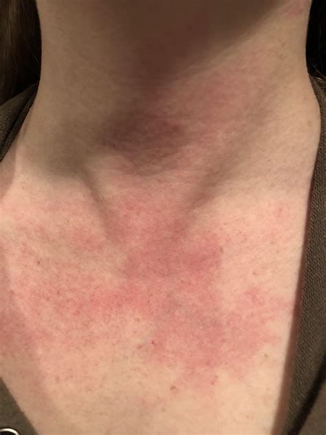 Is it normal for a rash to turn purple?