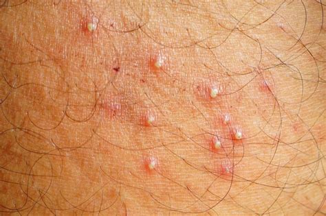 Is it normal for folliculitis to itch?