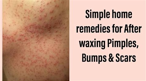 Is it normal to get pimples after Brazilian wax?