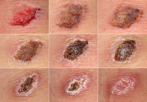 Is it normal to have a scab for months?