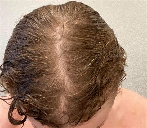 Is it normal to see scalp when hair is oiled?