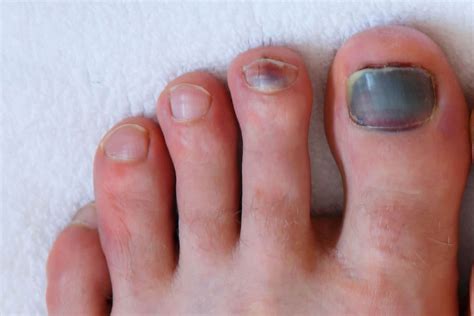 Is it okay to leave blood under toenail?