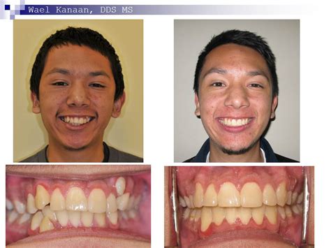 Is it okay to live with crooked teeth?