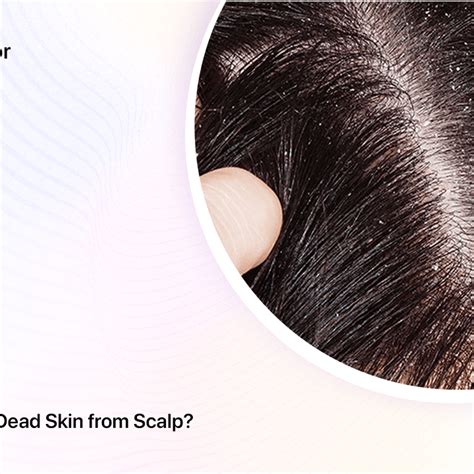 Is it okay to remove dead skin from scalp?