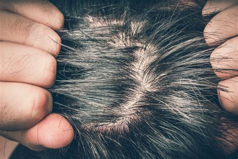 Is it okay to scratch your scalp with nails?