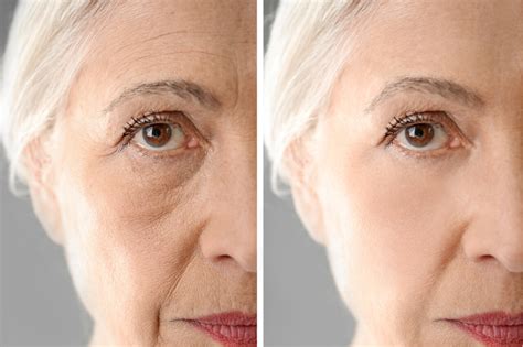 Is it possible to not have wrinkles at 40?