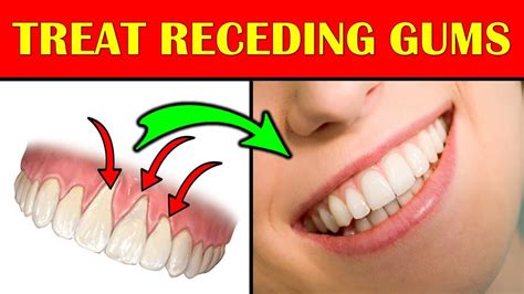 Is it possible to regrow gum tissue?