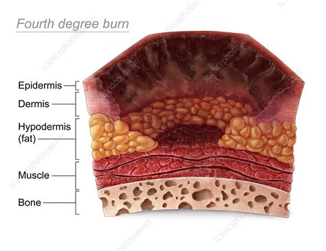 Is it possible to survive a 4th degree burn?