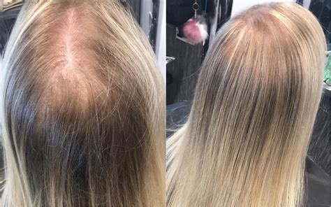 Is it safe to dye thinning hair?