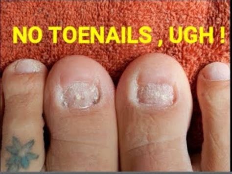 Is it safe to have no toenails?