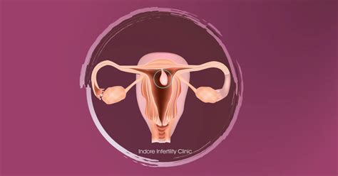Is it safe to leave a uterine polyp?