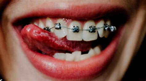 Is it safe to tongue kiss with braces?