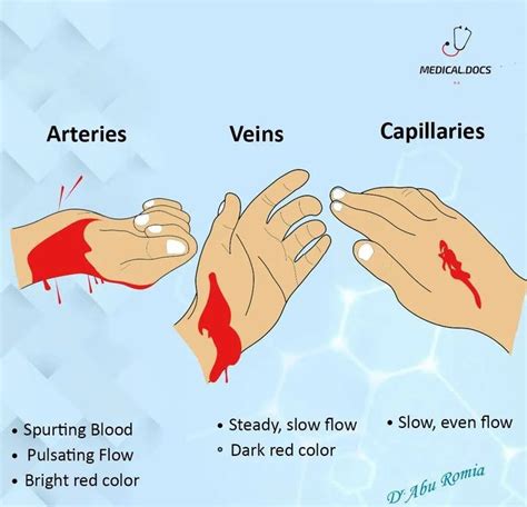 Is it worse to cut a vein or artery?