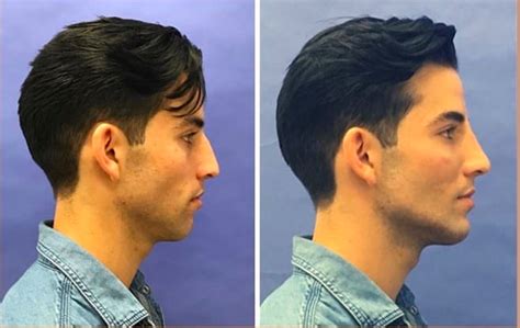 Is jawline related to testosterone?
