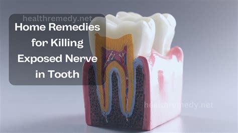 Is killing tooth nerve painful?