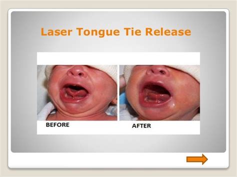 Is laser better than tongue-tie snip?