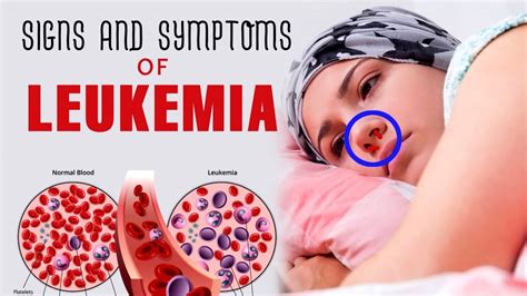 Is leukemia easy to miss?