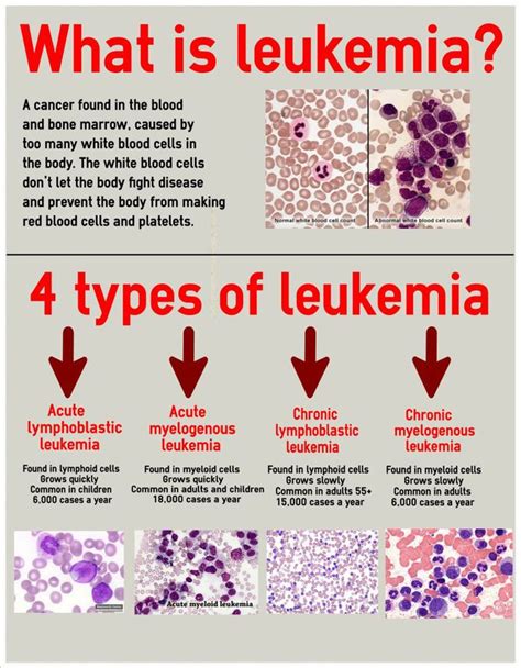 Is leukemia visible?