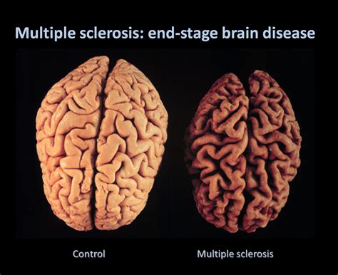 Is life normal with MS?