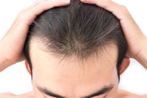 Is long hair worse for balding?