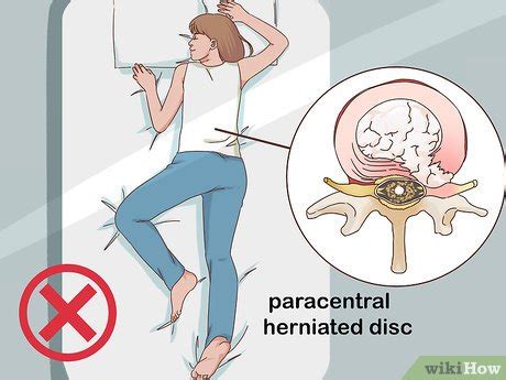 Is lying down good for herniated disc?