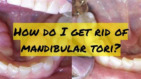 Is mandibular tori harmful?