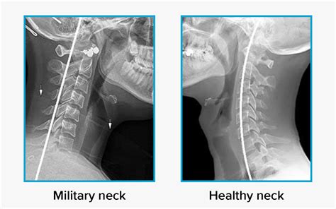 Is military neck a real thing?