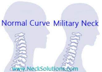 Is military neck normal?