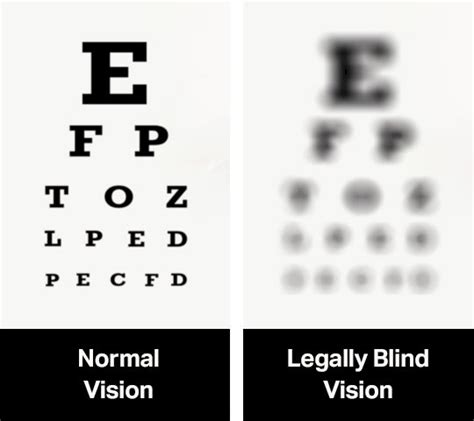 Is minus 0.50 eyesight bad?