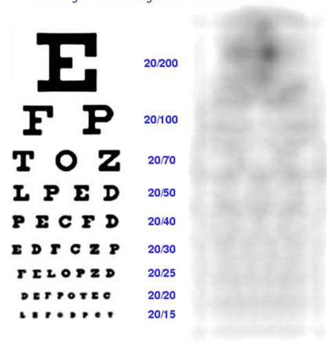 Is minus 10 eyesight bad?