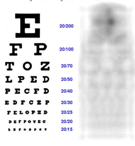 Is minus 7 eyesight bad?