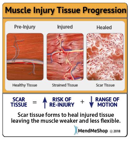 Is muscle damage permanent?