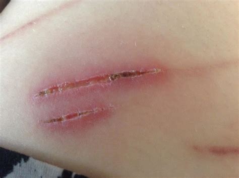 Is my cut infected or just healing?
