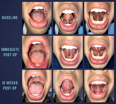 Is my frenulum too short?