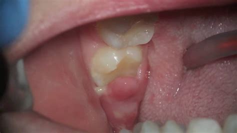 Is my tooth infected or just sore?