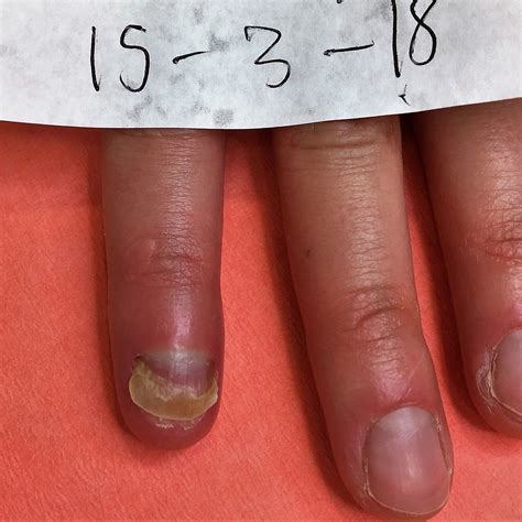 Is nail Bed Damage permanent?