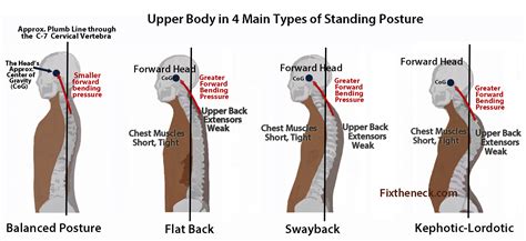 Is neck posture reversible?